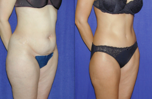 Mini Tummy Tuck vs. Full Tummy Tuck: What is the Difference? - Arkansas  Plastic Surgery