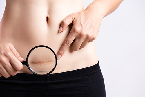 Close up of a woman's lower abdomen, who is pointing to her c-section scar and holding a magnifying glass in front of it.