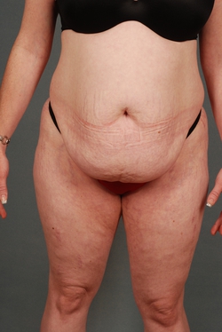 Plus Size Tummy Tuck ®: A Paradigm Shift, Blog