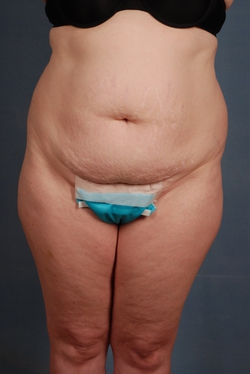 Plus Size Tummy Tuck ®: A Paradigm Shift, Blog