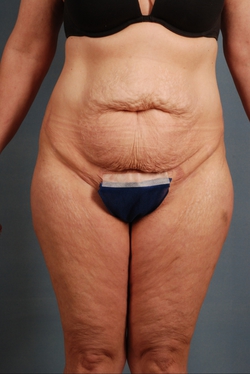 Abdominoplasty for Plus Size Women